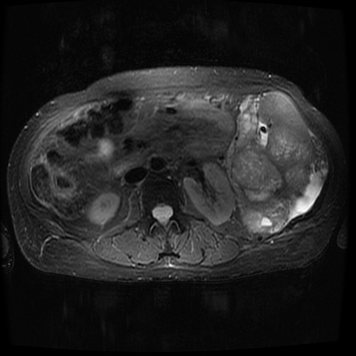 File:Acinar cell carcinoma of the pancreas (Radiopaedia 75442-86668 Axial T2 fat sat 44).jpg