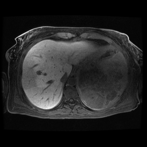 Acinar cell carcinoma of the pancreas (Radiopaedia 75442-86668 Axial late phase (~30 mins) 114).jpg