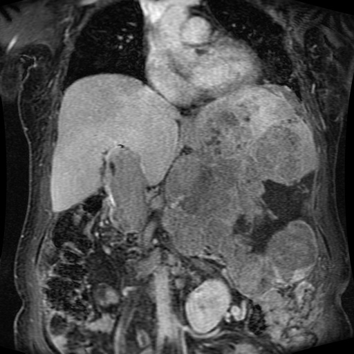 File:Acinar cell carcinoma of the pancreas (Radiopaedia 75442-86668 Coronal T1 C+ fat sat 110).jpg