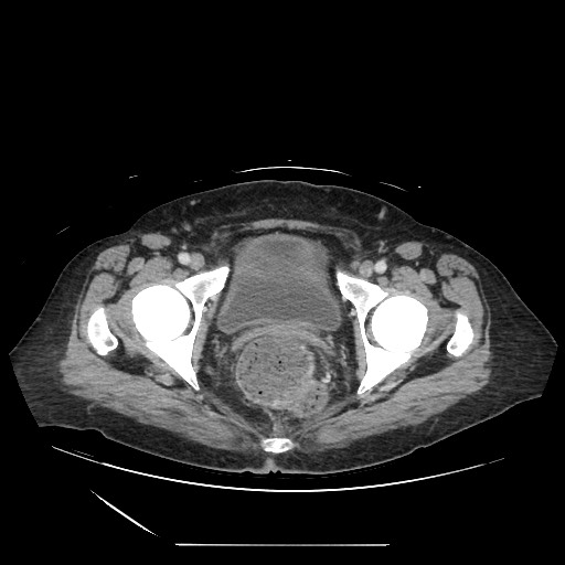 Acinar cell carcinoma of the pancreas (Radiopaedia 75442-86669 Axial C+ portal venous phase 140).jpg