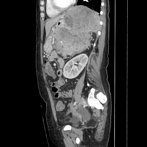 File:Acinar cell carcinoma of the pancreas (Radiopaedia 75442-86669 Sagittal C+ portal venous phase 123).jpg