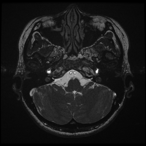 File:Acoustic neuroma (Radiopaedia 34049-35283 Axial 35).png