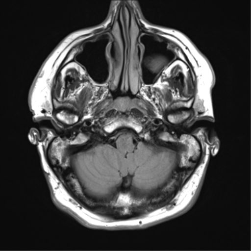 File:Acoustic schwannoma (Radiopaedia 50846-56358 Axial FLAIR 5).png