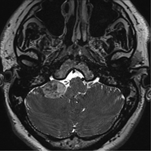 File:Acoustic schwannoma (Radiopaedia 50846-56358 Axial T2 9).png