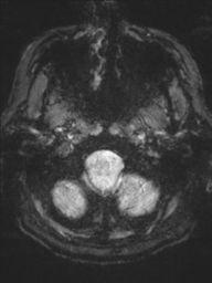 Acoustic schwannoma (Radiopaedia 55729-62281 Axial SWI 3).png