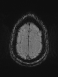 Acoustic schwannoma (Radiopaedia 55729-62281 Axial SWI 46).png