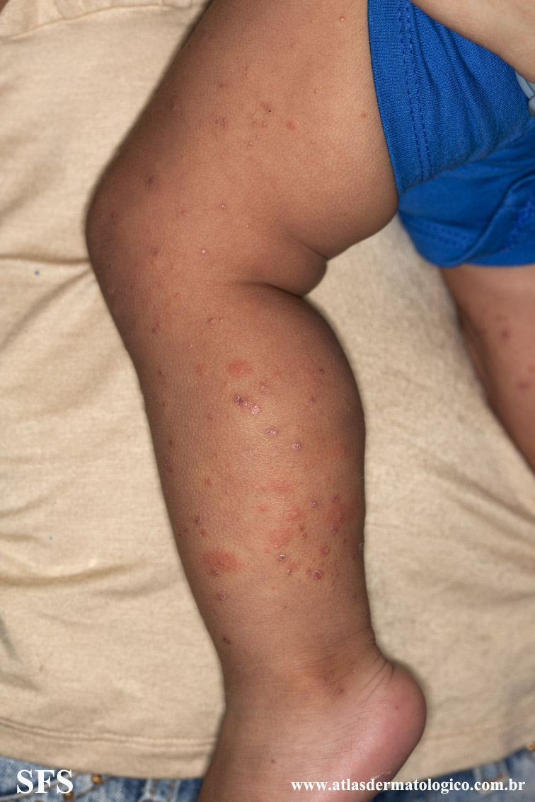 Acrodermatitis Infantile Papular (Dermatology Atlas 33).jpg