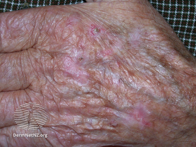 File:Actinic keratoses affecting the hands (DermNet NZ lesions-ak-hands-546).jpg