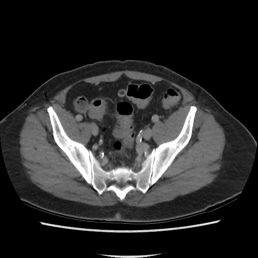 File:Active colonic bleed on CT (Radiopaedia 49765-55025 Axial C+ delayed 67).jpg