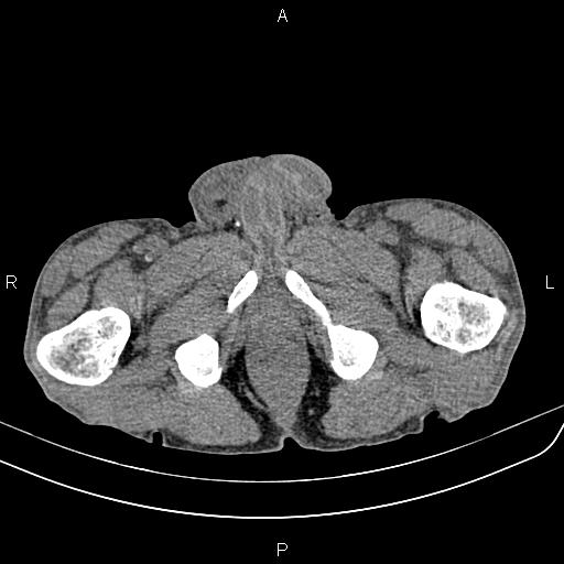 File:Active crohn disease (Radiopaedia 87133-103397 Axial non-contrast 108).jpg