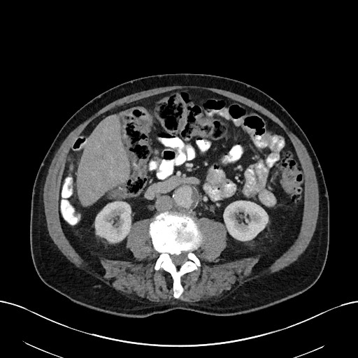 File:Active lower gastrointestinal bleeding - diverticular (Radiopaedia 61203-69106 Axial C+ portal venous phase 66).jpg