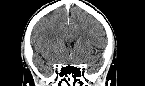 File:Active neurocysticercosis before and after therapy (Radiopaedia 71710-82099 Coronal C+ delayed 30).jpg