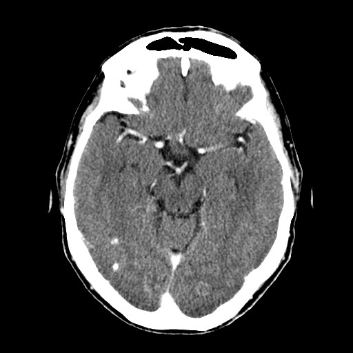 File:Active neurocysticercosis before and after therapy (Radiopaedia 71710-82100 Axial C+ delayed 31).jpg