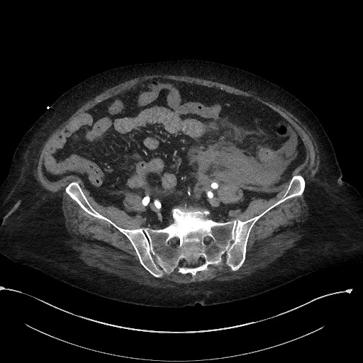 File:Active renal extravasation with large subcapsular and retroperitoneal hemorrhage (Radiopaedia 60975-68796 Axial C+ arterial phase 139).jpg