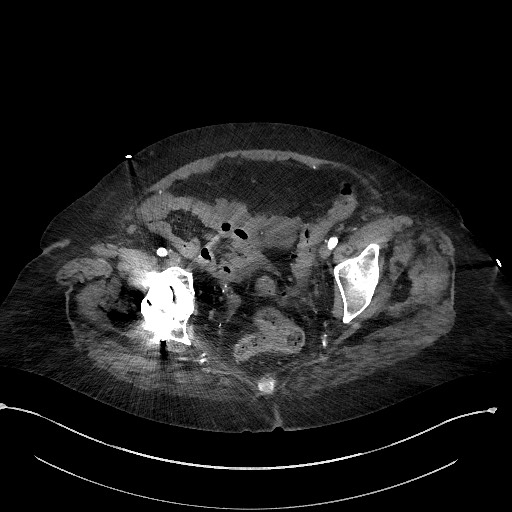 Active renal extravasation with large subcapsular and retroperitoneal hemorrhage (Radiopaedia 60975-68796 Axial C+ arterial phase 176).jpg