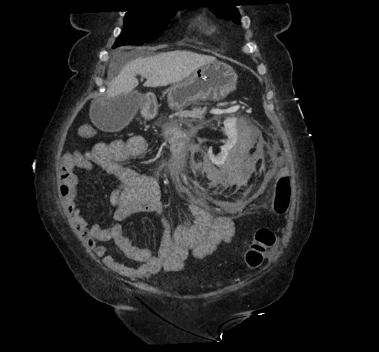 File:Active renal extravasation with large subcapsular and retroperitoneal hemorrhage (Radiopaedia 60975-68796 Coronal C+ portal venous phase 49).jpg