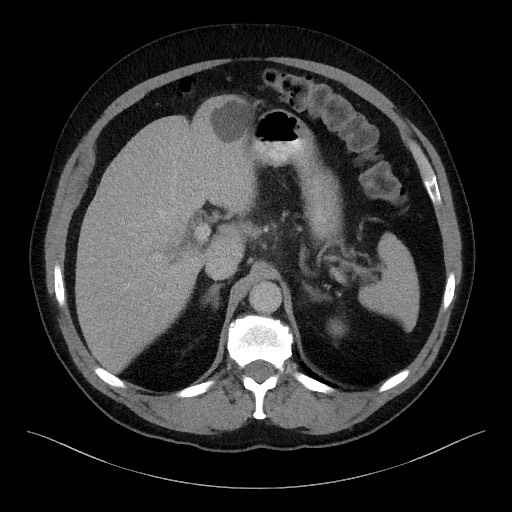 Acute-on-chronic pancreatitis (Radiopaedia 67286-76656 Axial C+ portal venous phase 21).jpg