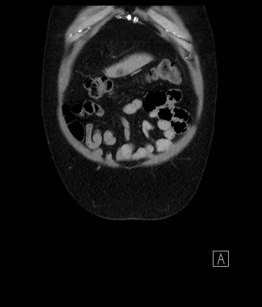 Acute-on-chronic pancreatitis (Radiopaedia 67286-76656 Coronal C+ portal venous phase 15).jpg