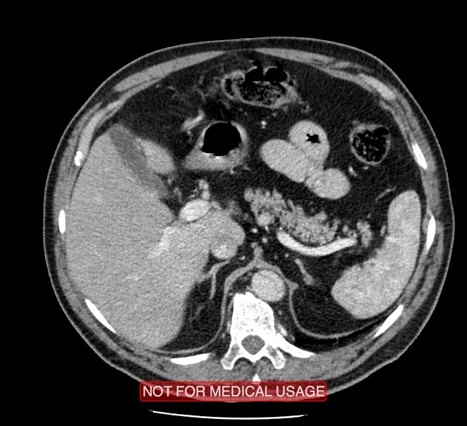 Acute aortic dissection - Stanford type A (Radiopaedia 40661-43285 Axial C+ portal venous phase 74).jpg