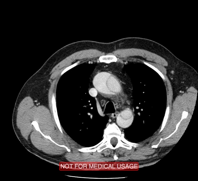 Acute aortic dissection - Stanford type A (Radiopaedia 40661-43285 Axial C+ portal venous phase 9).jpg