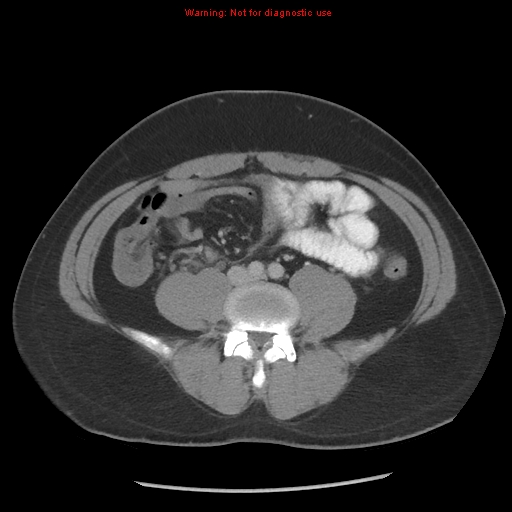 File:Acute appendicitis (Radiopaedia 10498-10973 Axial C+ portal venous phase 12).jpg