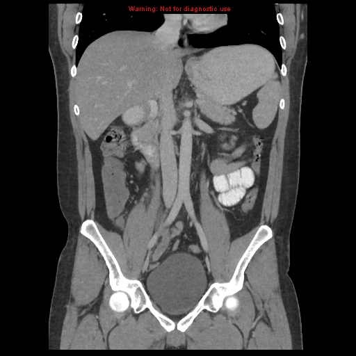 File:Acute appendicitis (Radiopaedia 10498-10973 F 19).jpg