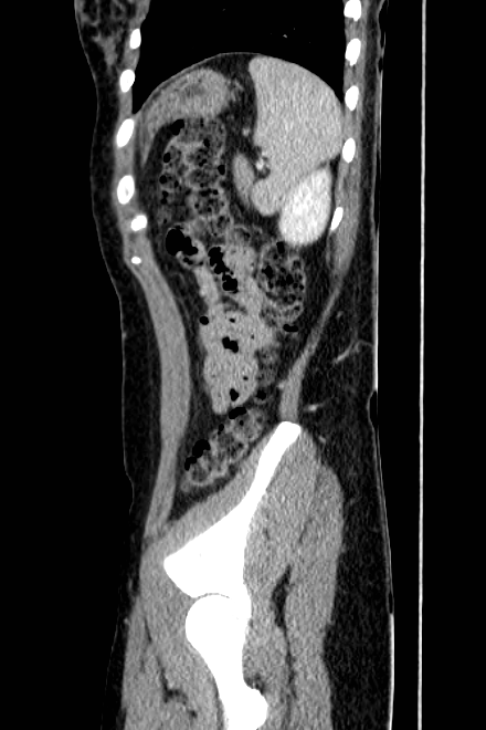 Acute appendicitis (Radiopaedia 22892-22918 Sagittal C+ portal venous phase 73).png