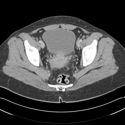 Acute appendicitis (Radiopaedia 30297-30934 Axial C+ portal venous phase 72).jpg