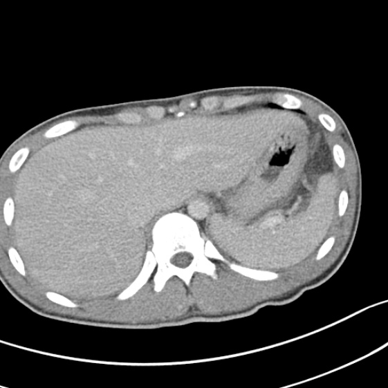 Acute appendicitis (Radiopaedia 32614-33572 Axial C+ portal venous phase 9).jpg