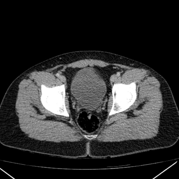 Acute appendicitis (Radiopaedia 38255-40270 Axial C+ portal venous phase 102).jpg