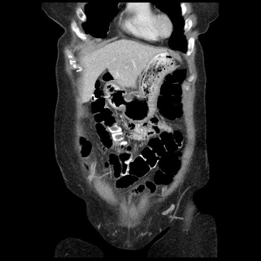 Acute appendicitis (Radiopaedia 52672-58589 Coronal C+ portal venous phase 6).jpg