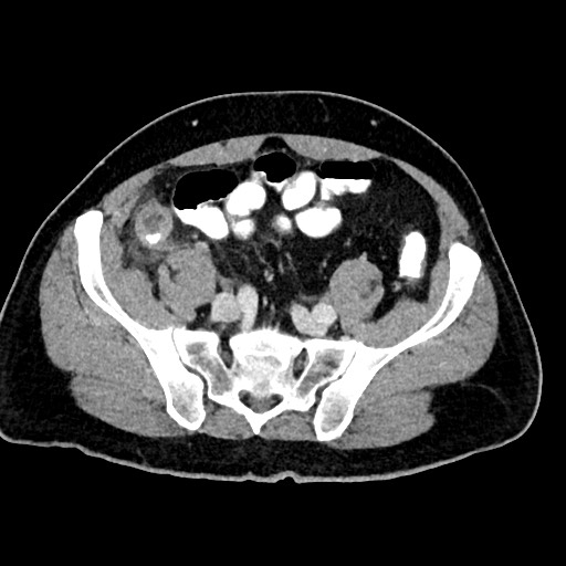 Acute appendicitis (Radiopaedia 77016-88960 Axial C+ portal venous phase 107).jpg