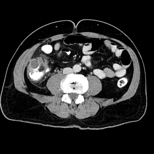 Acute appendicitis (Radiopaedia 77016-88960 Axial C+ portal venous phase 86).jpg