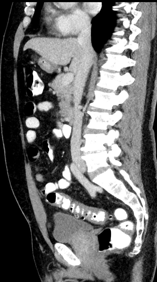 Acute appendicitis (Radiopaedia 77016-88960 Sagittal C+ portal venous phase 63).jpg