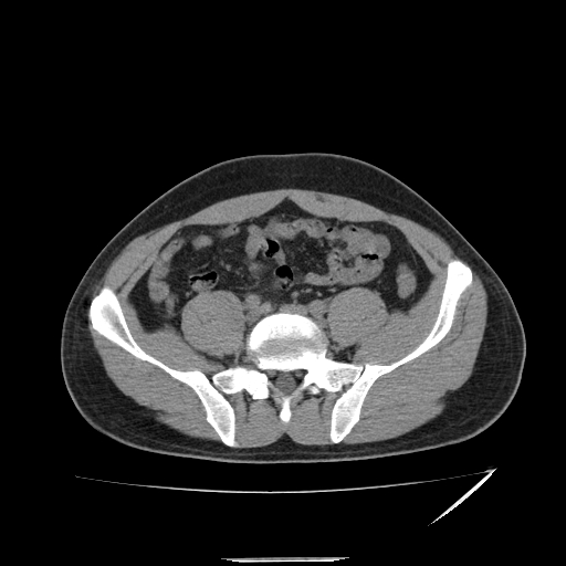 File:Acute appendicitis (Radiopaedia 81320-95015 A 5).jpg