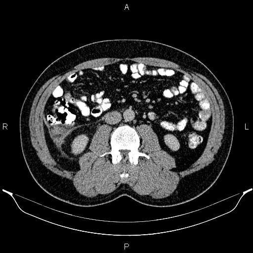 Acute appendicitis (Radiopaedia 84780-100240 Axial C+ portal venous phase 53).jpg