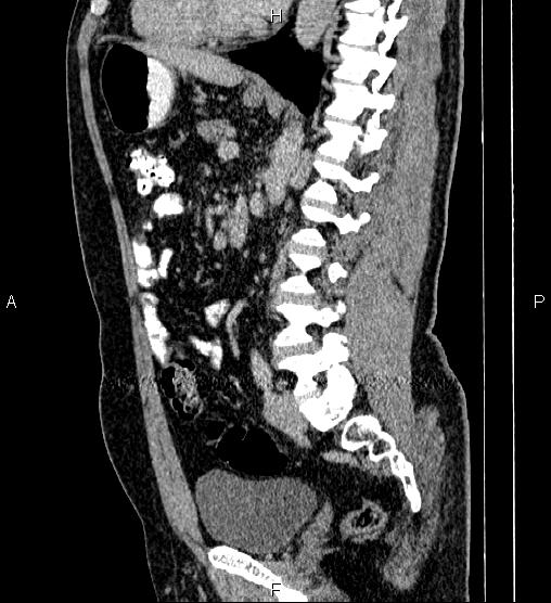 File:Acute appendicitis (Radiopaedia 84780-100240 Sagittal C+ portal venous phase 60).jpg