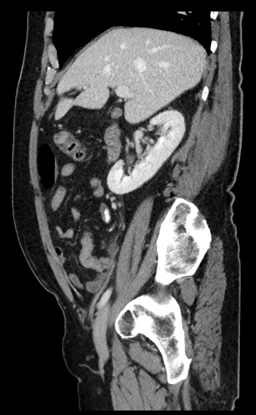 Acute appendicitis - large appendicoliths (Radiopaedia 61805-69820 Sagittal C+ portal venous phase 78).jpg