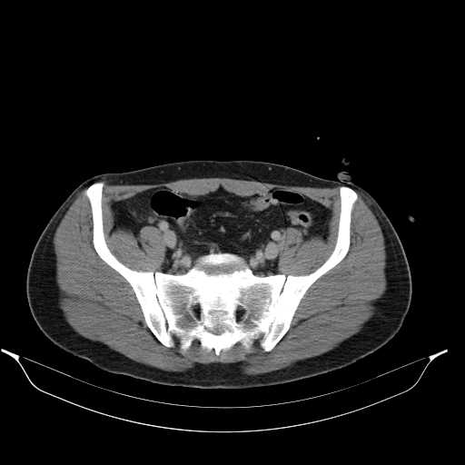 File:Acute appendicitis with appendicoliths (Radiopaedia 21148-21062 Axial C+ portal venous phase 17).jpg