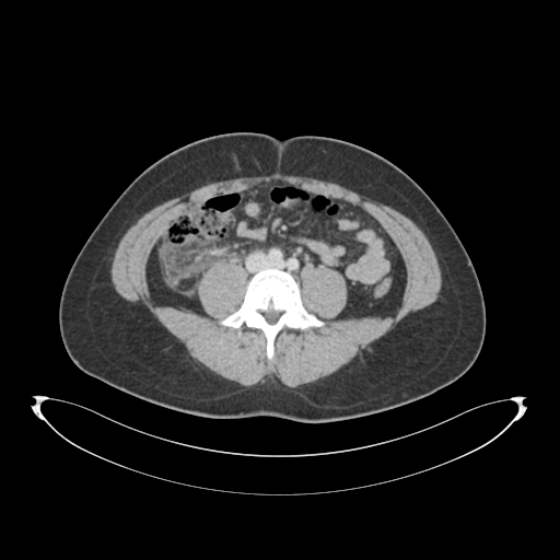 Acute appendicitis with appendicoliths (Radiopaedia 50186-55532 Coronal C+ portal venous phase 1).png