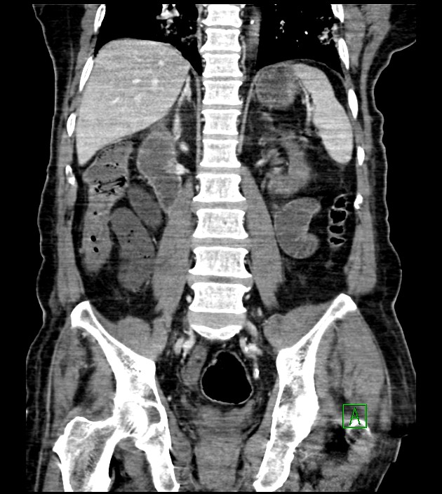 Acute arterial mesenteric ischemia (Radiopaedia 78238-90828 Coronal C+ portal venous phase 60).jpg