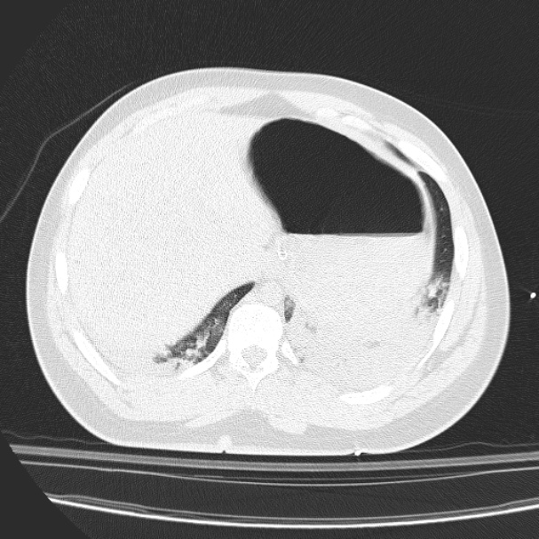 Acute aspiration pneumonitis (Radiopaedia 33605-34703 Axial lung window 84).jpg