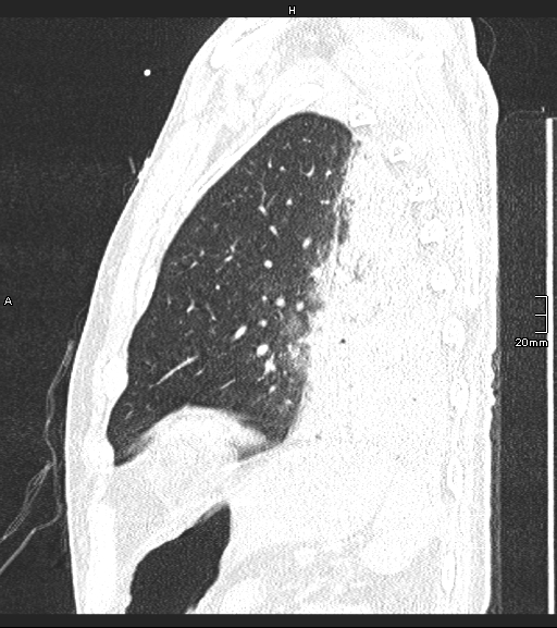 File:Acute aspiration pneumonitis (Radiopaedia 55642-62166 Sagittal lung window 27).jpg
