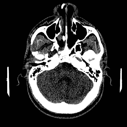 Acute basilar artery occlusion (Radiopaedia 43582-46985 Axial non-contrast 52).jpg