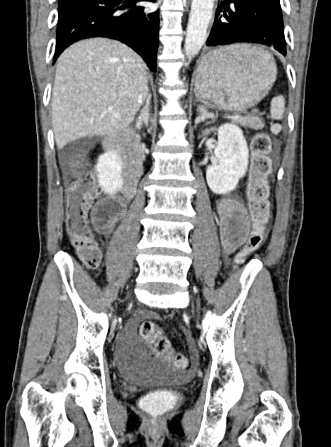 Acute bowel ischemia (Radiopaedia 87695-104114 Coronal C+ portal venous phase 246).jpg
