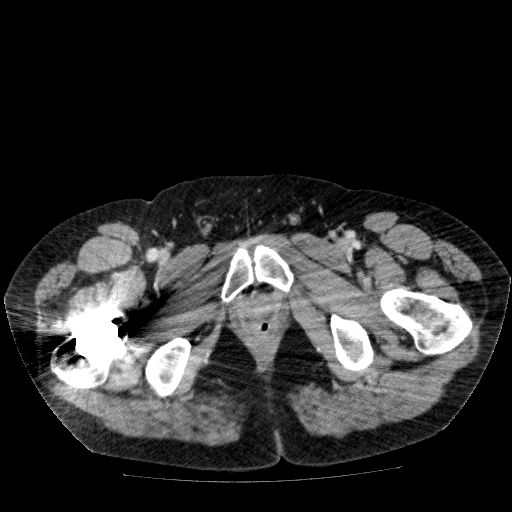 File:Acute cholecystitis and incidental left sided IVC (Radiopaedia 49352-54459 Axial C+ portal venous phase 160).jpg