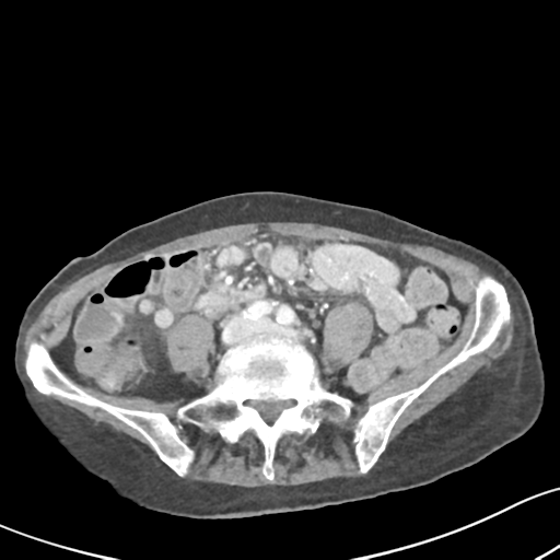 Acute cholecystitis with contained perforation (Radiopaedia 47328-51907 Axial C+ portal venous phase 46).png