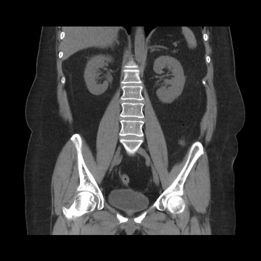 File:Acute cholecystitis with tensile fundus sign (Radiopaedia 71394-81723 Coronal non-contrast 76).jpg
