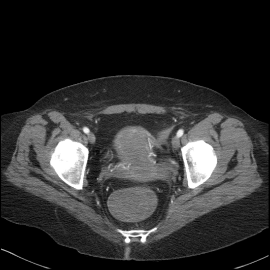 Acute colonic hemorrhage in ulcerative colitis (Radiopaedia 77415-89538 Axial C+ arterial phase 120).jpg