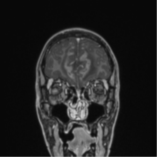 File:Acute disseminated encephalomyelitis (ADEM) (Radiopaedia 65319-74349 Coronal T1 C+ 55).png